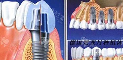德国种植体示意图