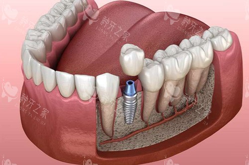 种牙坏了能二次种植吗？三大关键因素决定修复可能！