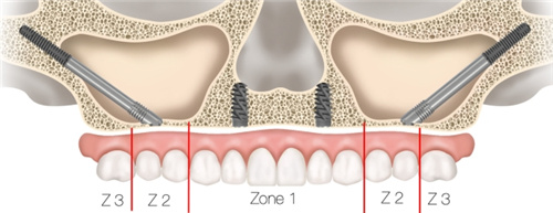 技术解析什么是穿翼板种植牙技术？穿的哪个骨？