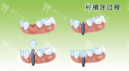 种植牙过程图片