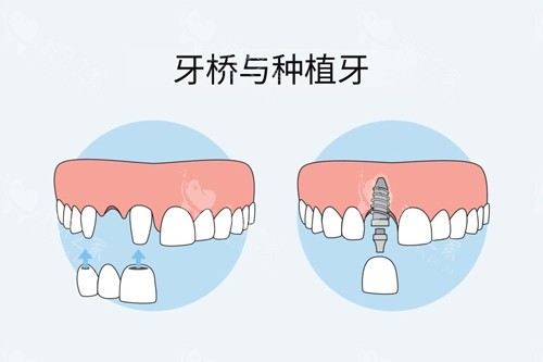 牙冠桥和种植牙对比图