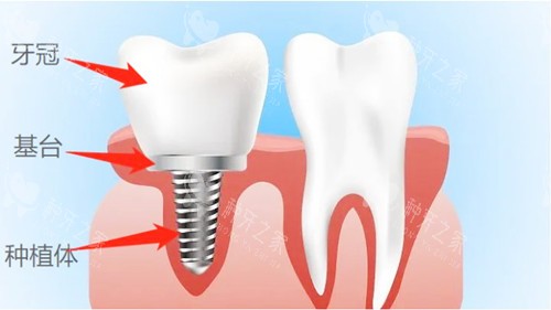 湖南新化优贝口腔种植牙价格表看看一颗牙要花多少钱?